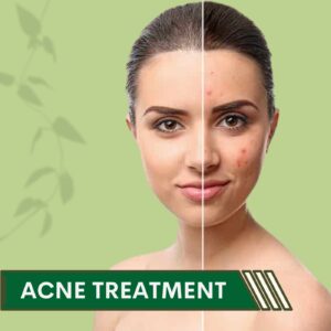 Acne treatment, Hormonal Imbalance, Radio Frequency, Majuragate, Athwa, Piplod, Surat, Gujarat