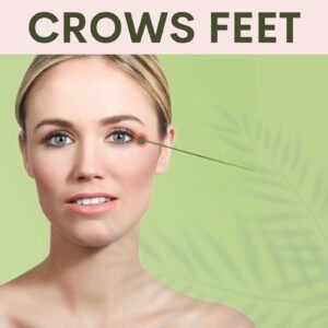 Crows Feet Correction | Botox Treatment | Surat, Ahmedabad, Gujarat, Mumbai, Pune, Maharashtra